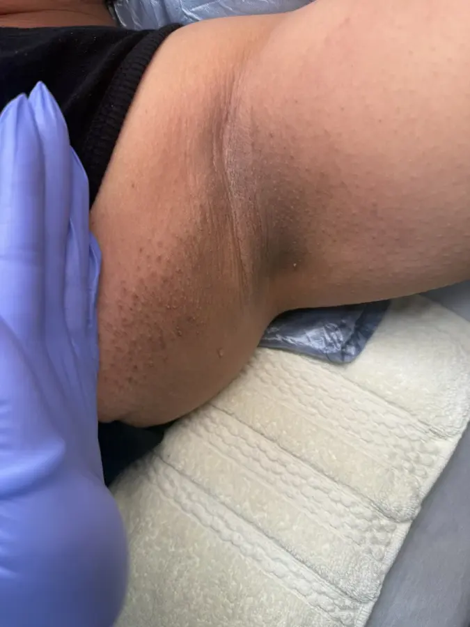 Underarm result pictured by Ryane Ashley